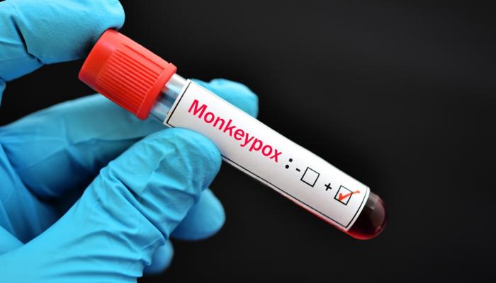 L&rsquo;Organisation mondiale de la santé met fin à l&rsquo;état d&rsquo;urgence lié à la variole du singe.